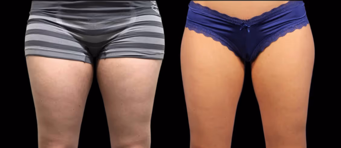 coolsculpting thighs before and after