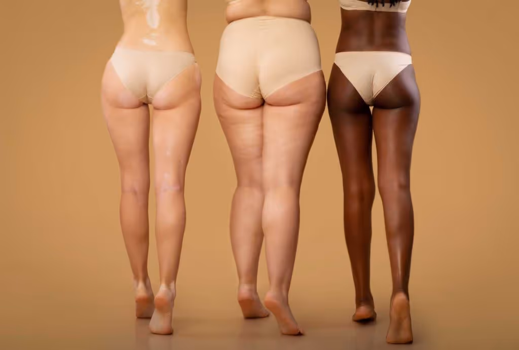coolsculpting thighs toronto