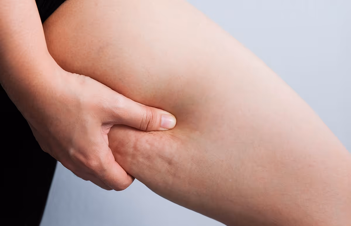 coolsculpting thighs canada