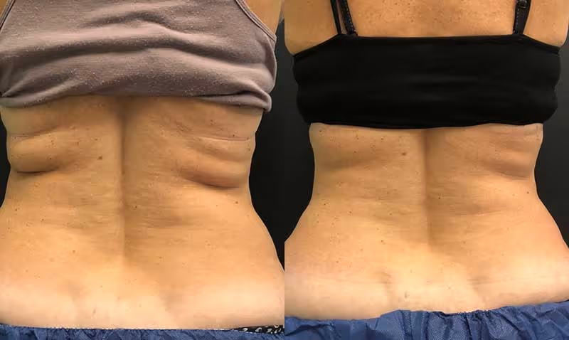 coolsculpting flanks before and after