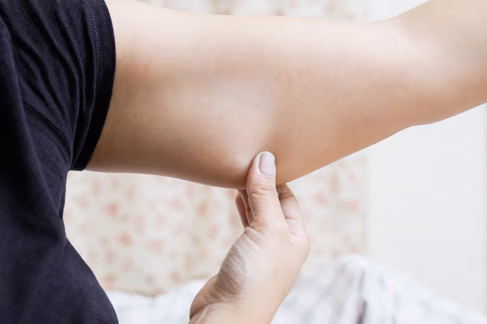 arm coolsculpting toronto