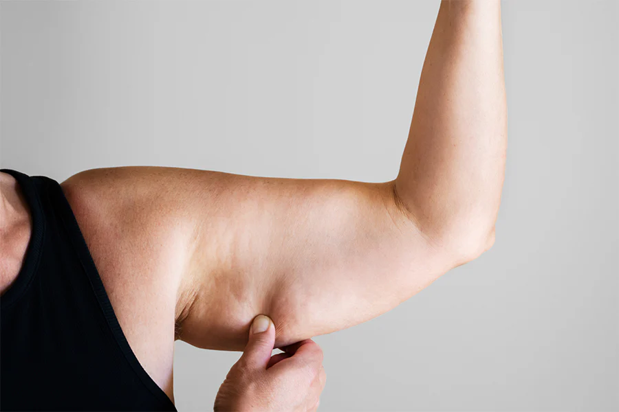 coolsculpting for arm