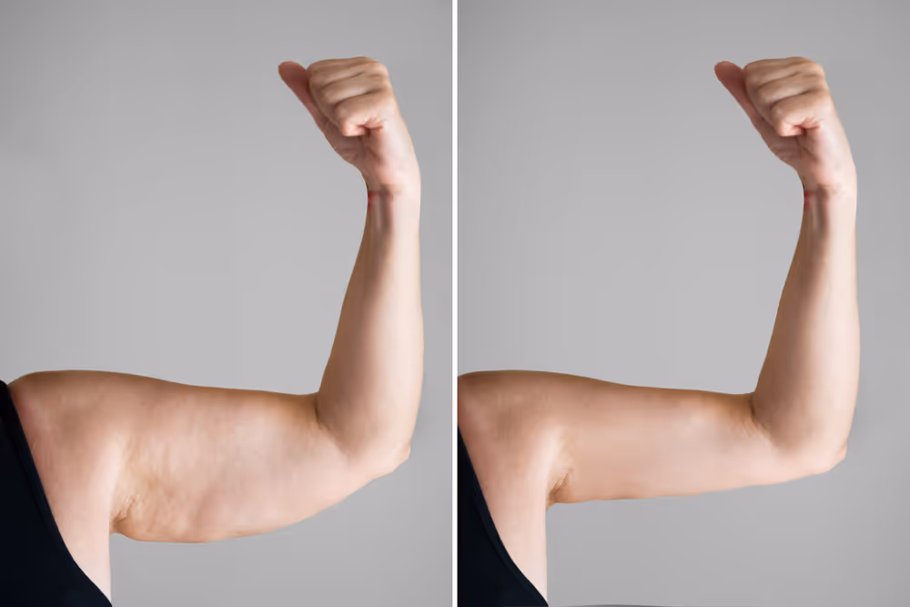 coolsculpting arm before and after
