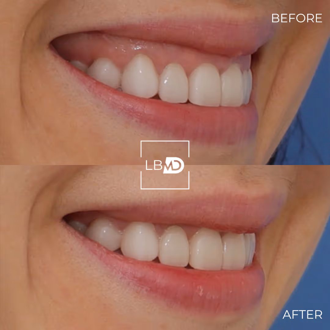 botox lip flip before and after