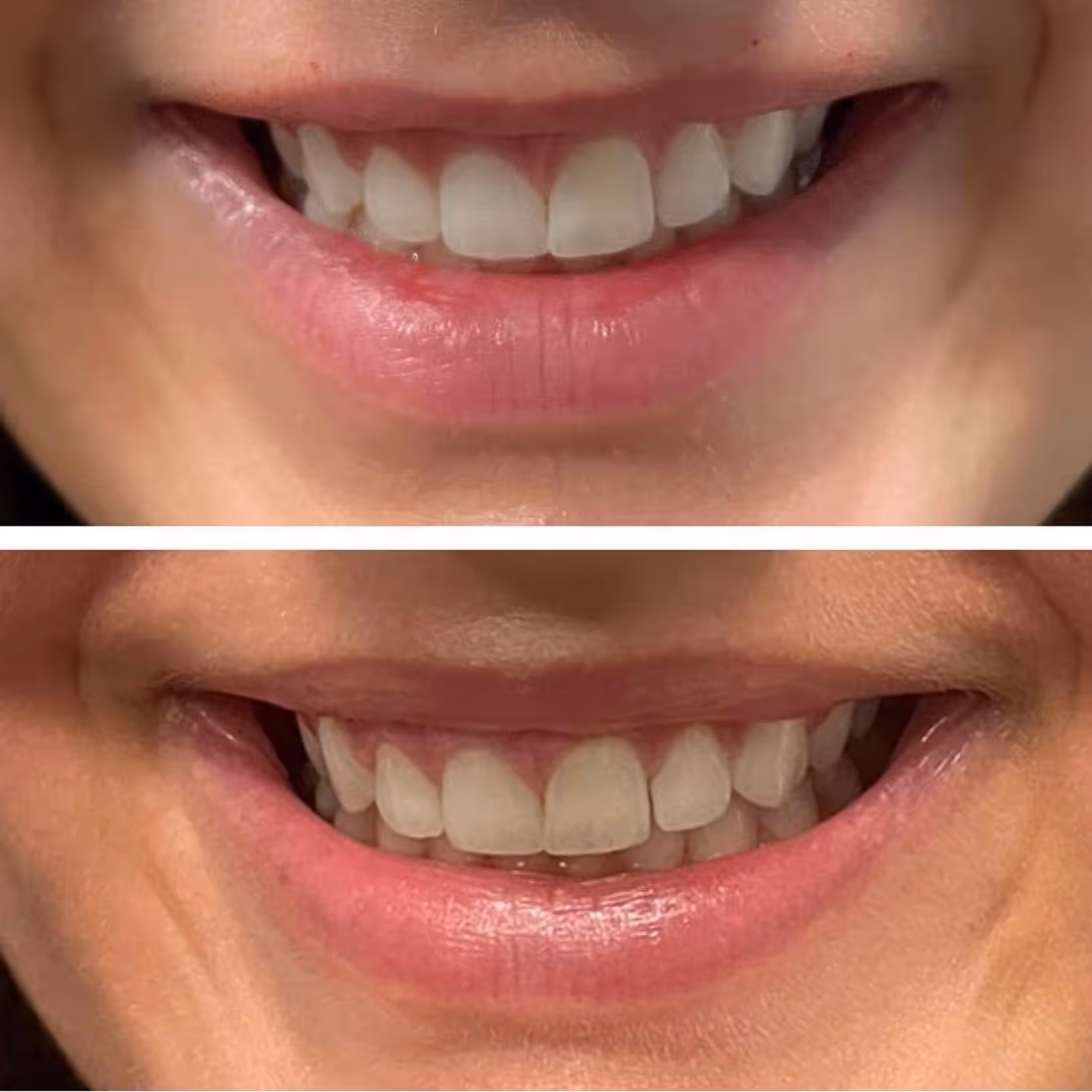 botox lip flip before and after