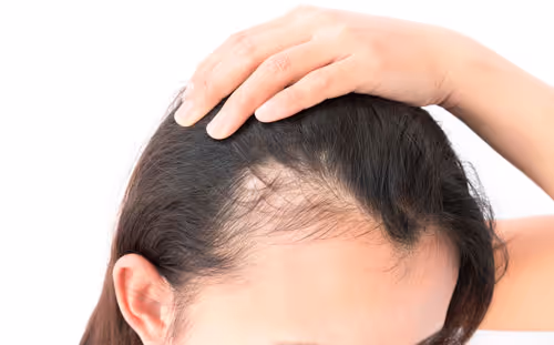 hair transplant richmond hill