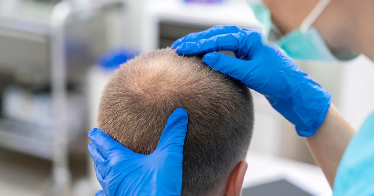 hair transplant in richmond hill