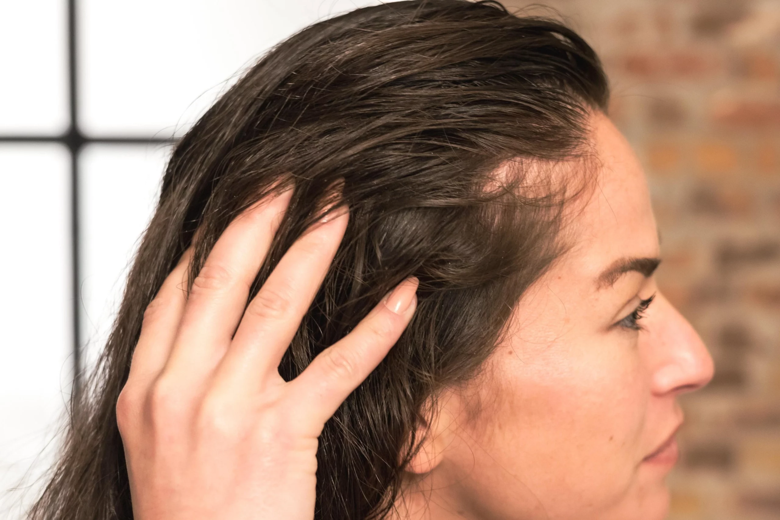 hair transplant brampton