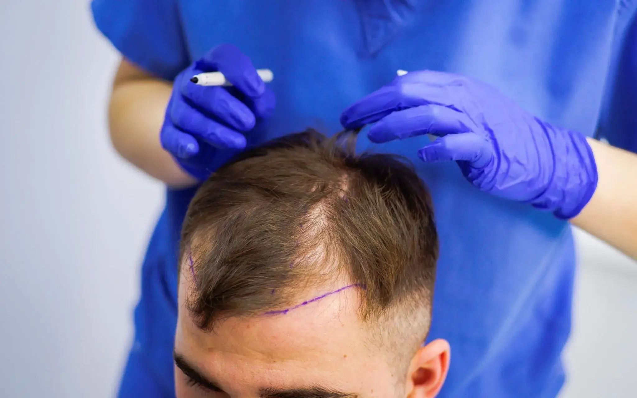 hair transplant brampton