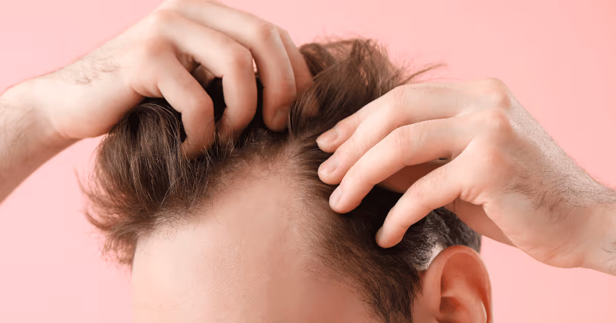 prp hair restoration in brampton