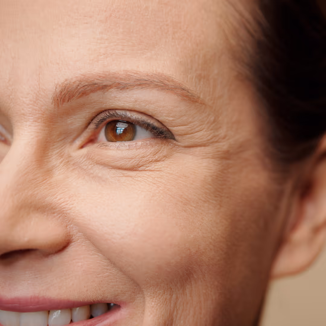 botox crows feet toronto
