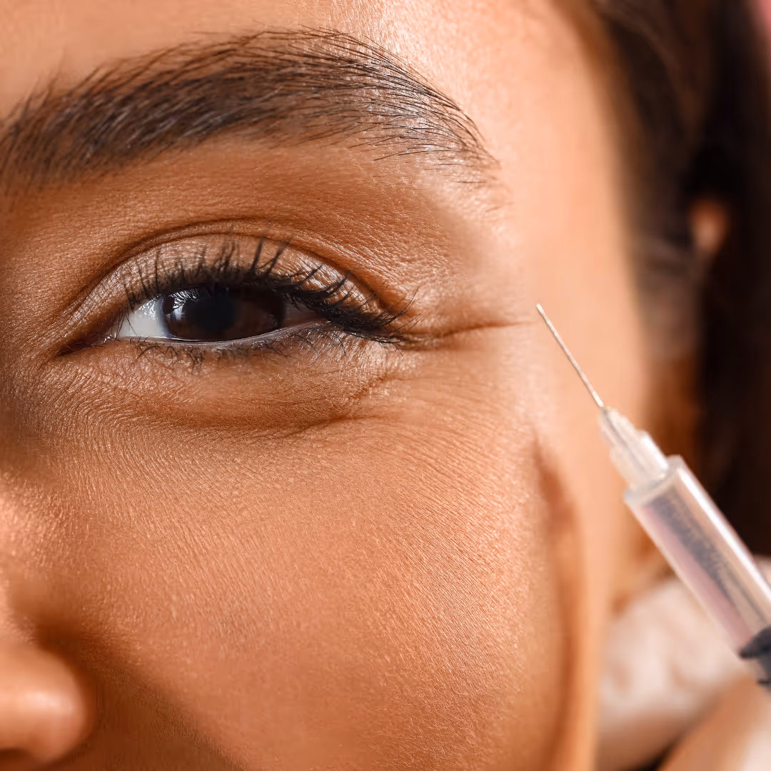 under eye dermal filler toronto