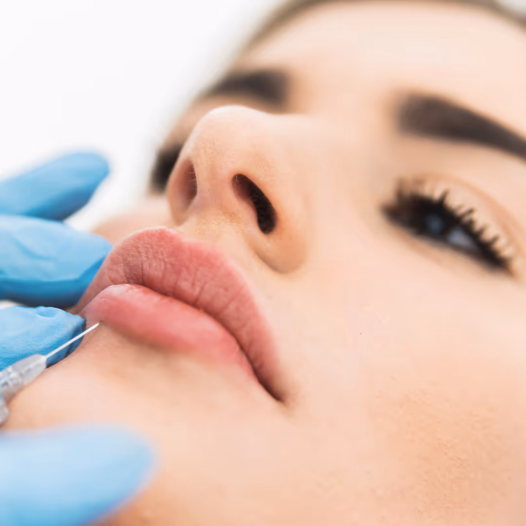 lip dermal filler toronto