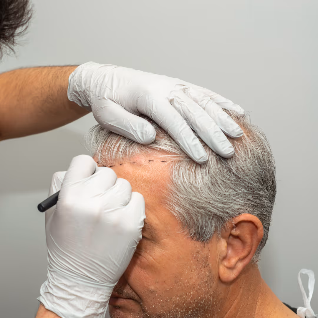 hair transplant male toronto