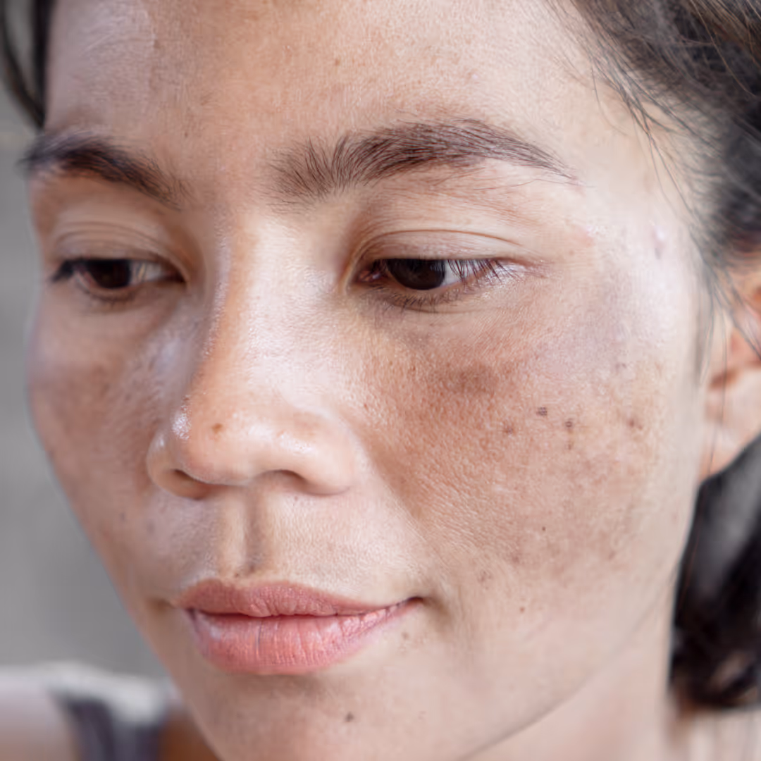 fraxel treatment 