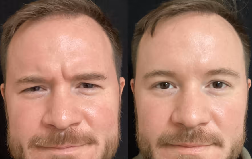 frown lines botox before and after