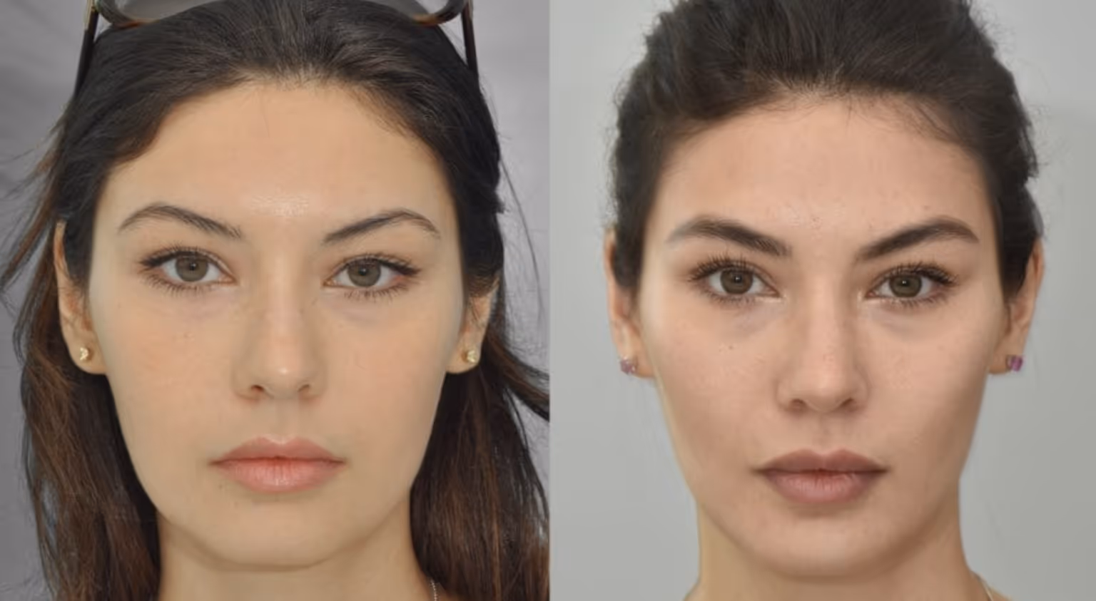 masseters botox before and after