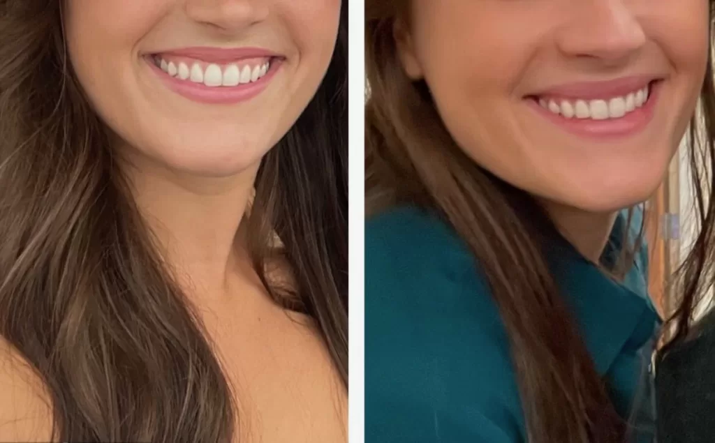 lip flip botox before and after