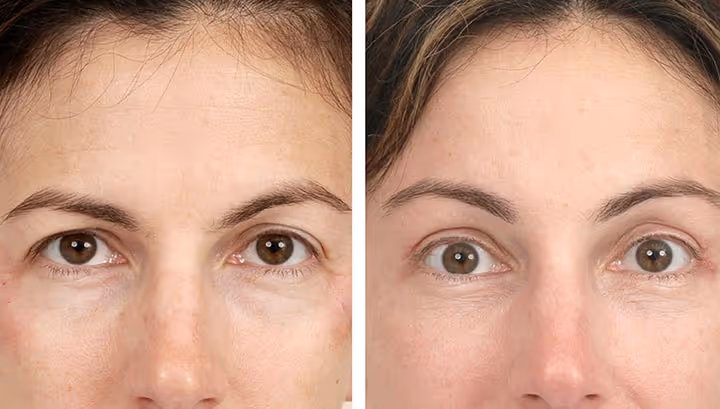 brow lift botox before and after