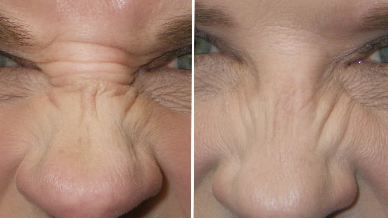 bunny lines botox before and after