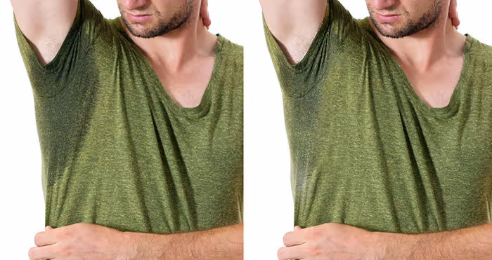 hyperhidrosis botox before and after