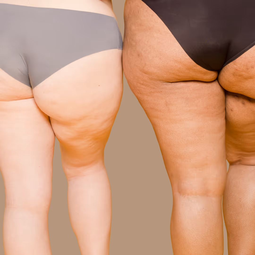 coolsculpting mississauga