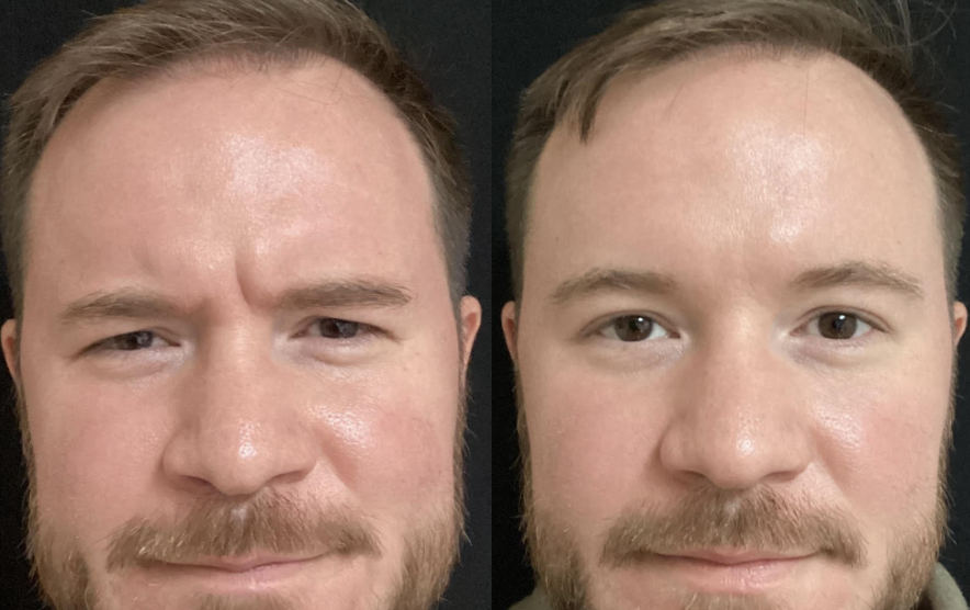 botox frown lines before and after