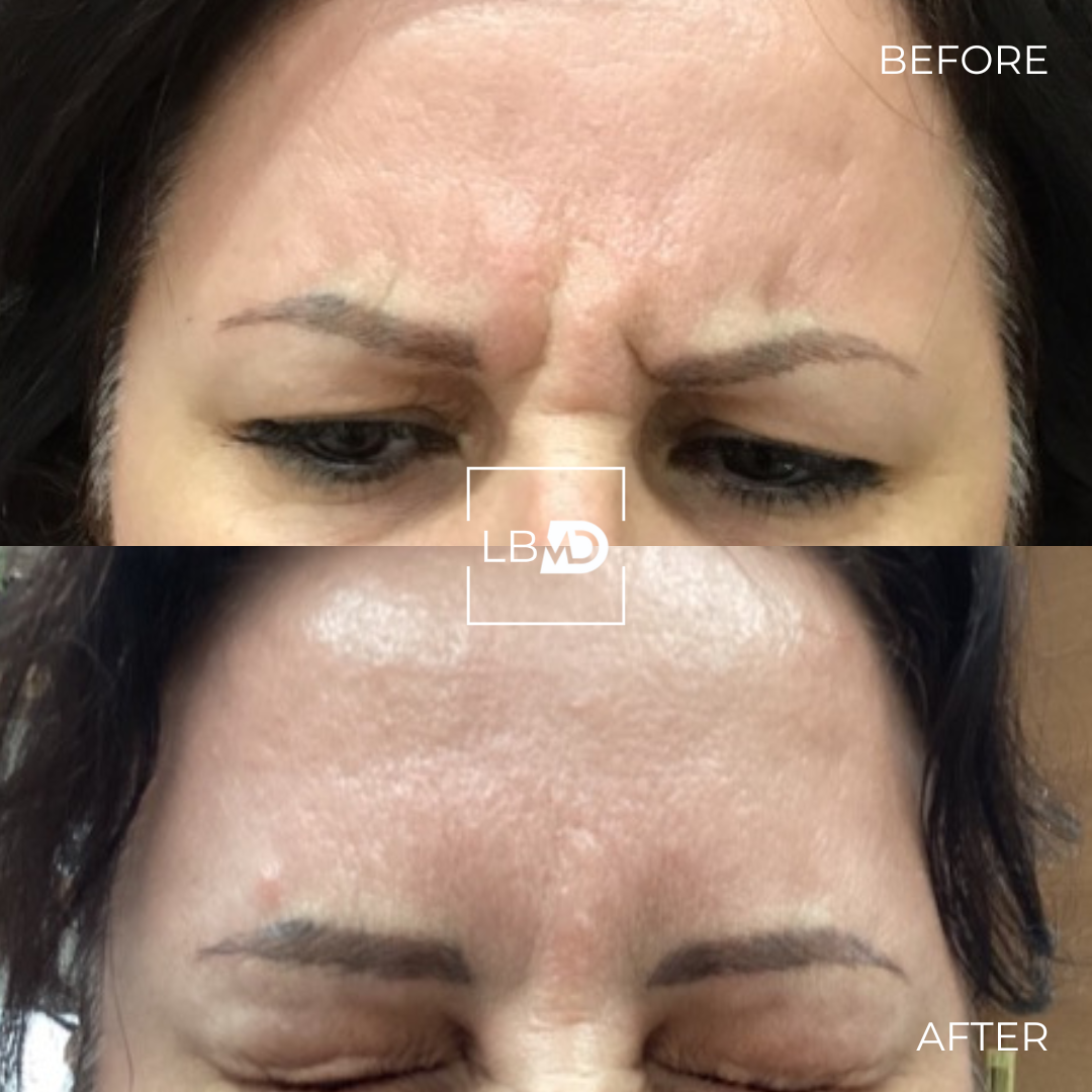 botox frown lines before and after