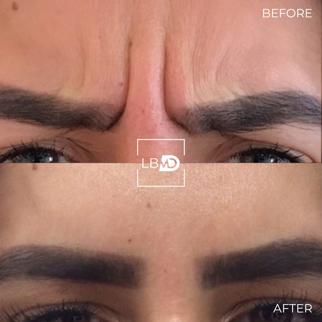 botox frown line before and after