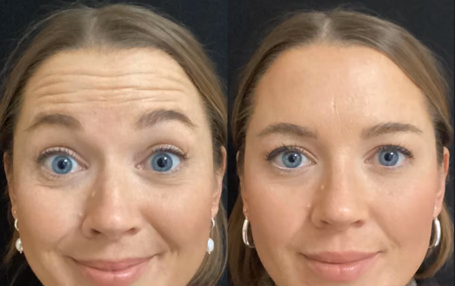 botox forehead line before and after
