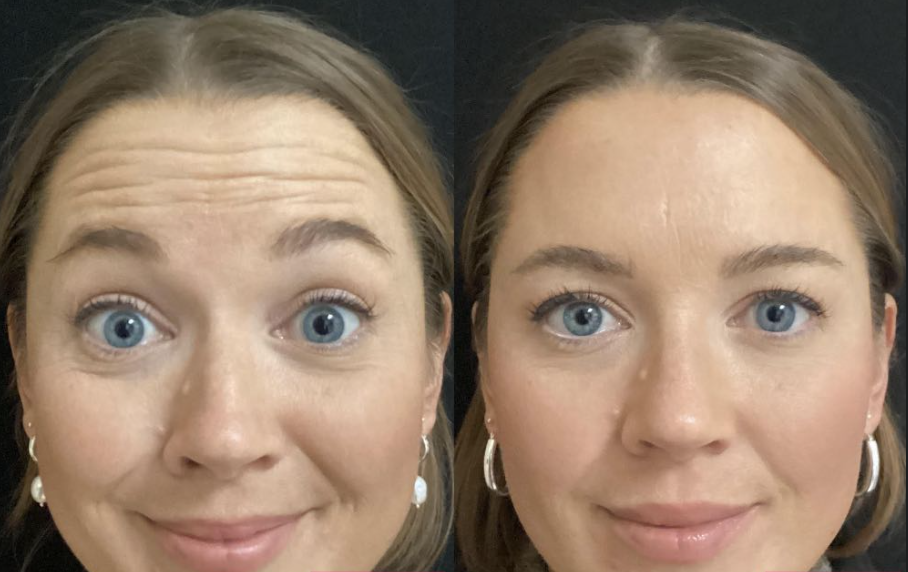 botox forehead line before and after