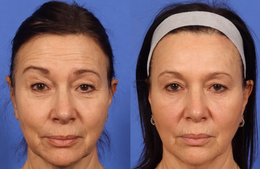 botox forehead lines before and after