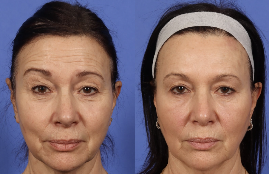 botox forehead lines before and after