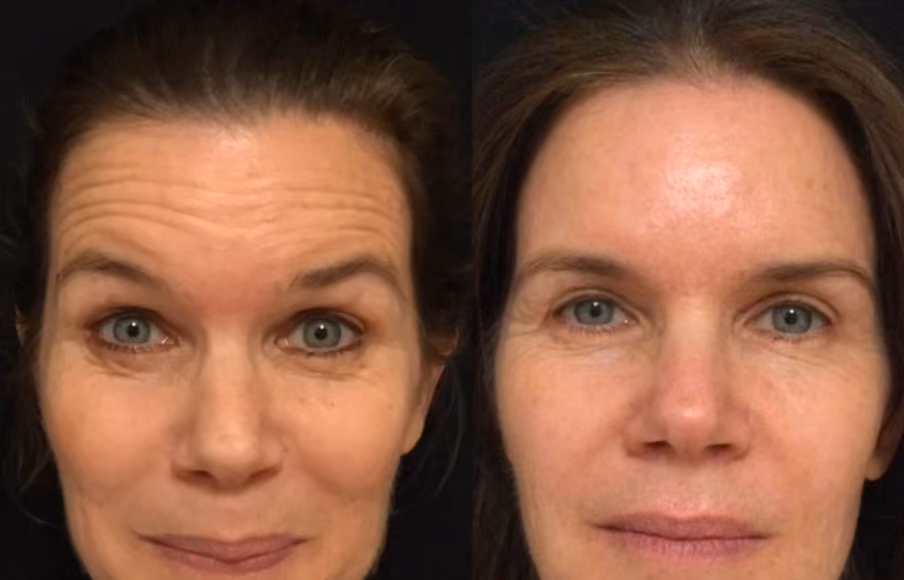 botox forehead line before and after