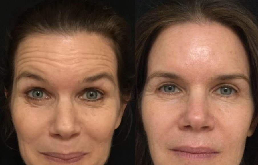 botox forehead line before and after