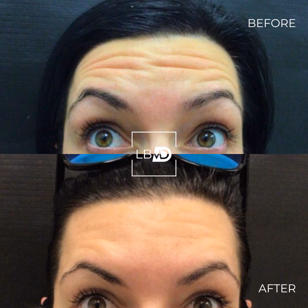 botox forehead lines before and after