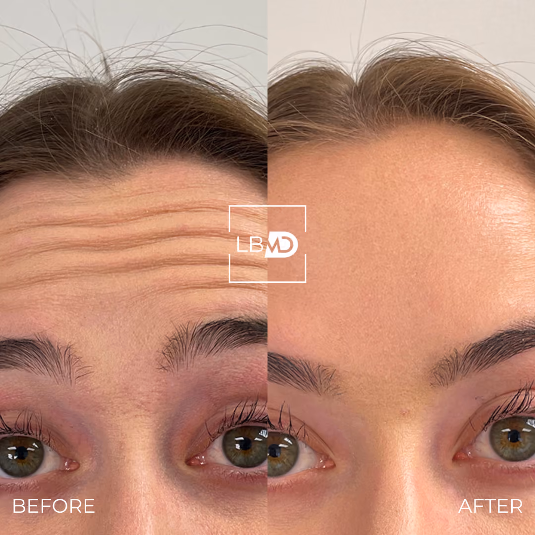 botox forehead lines before and after