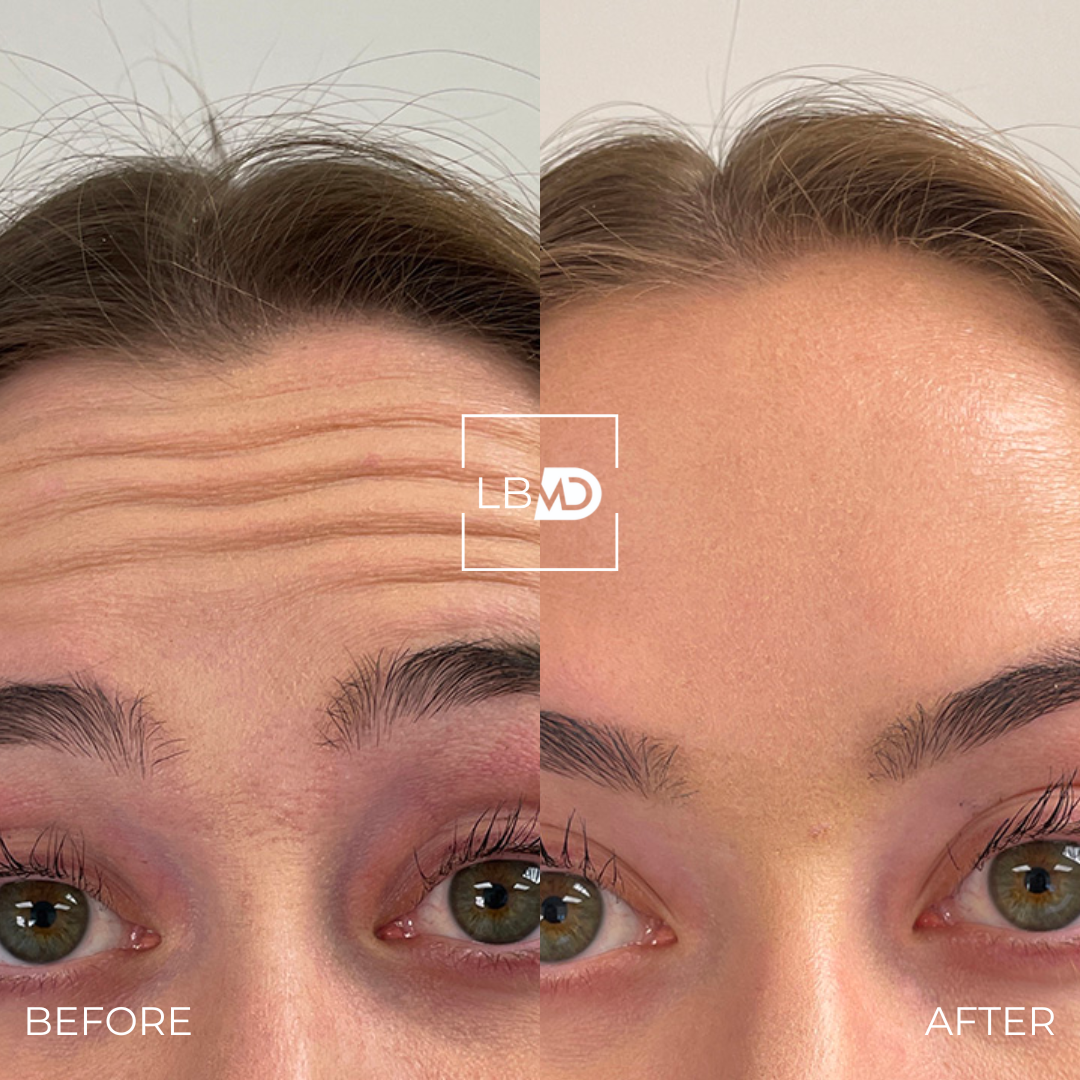 botox forehead lines before and after