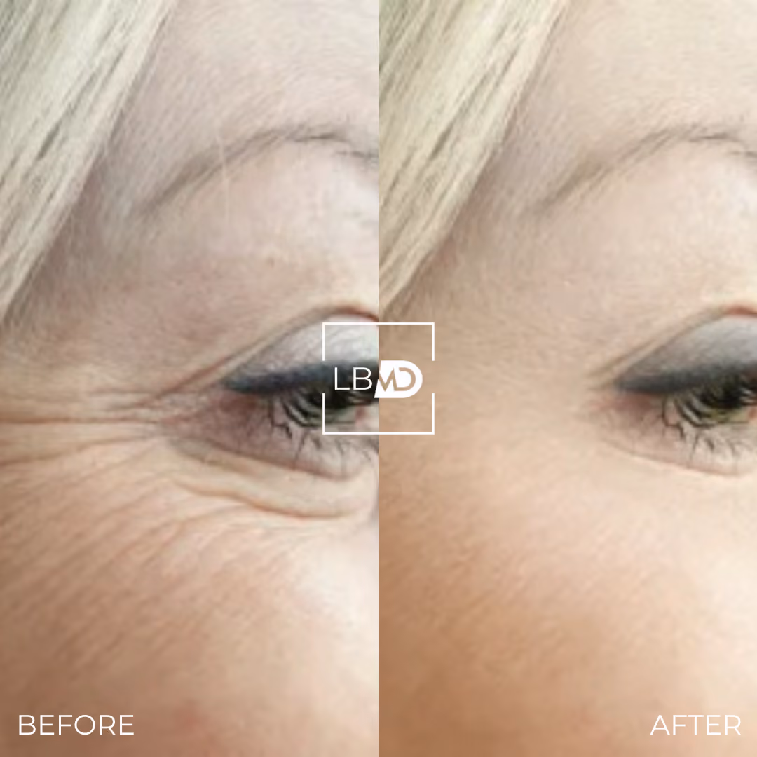 botox crows feet before and after