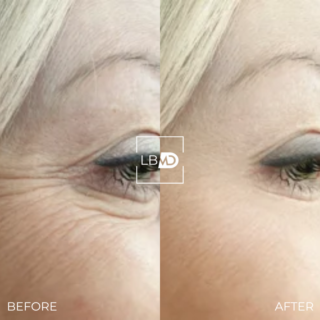 botox crows feet before and after