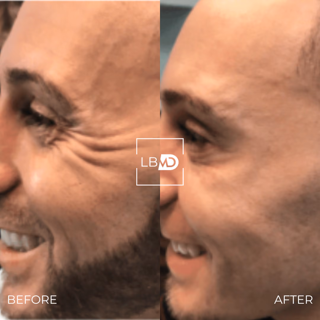 botox crows feet before and after
