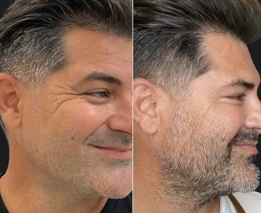 botox crows feet before and after