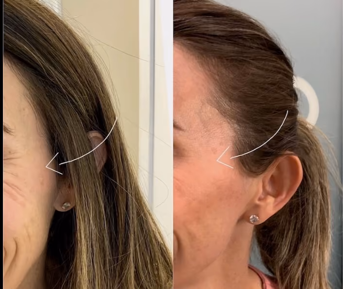 botox crows feet before and after