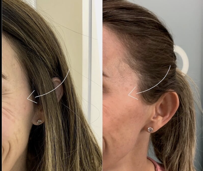 botox crows feet before and after