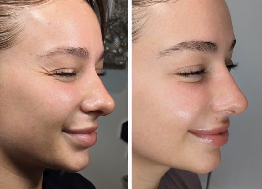 botox crows feet before and after