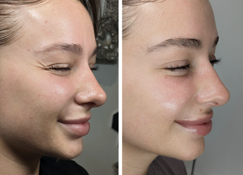 botox crows feet before and after