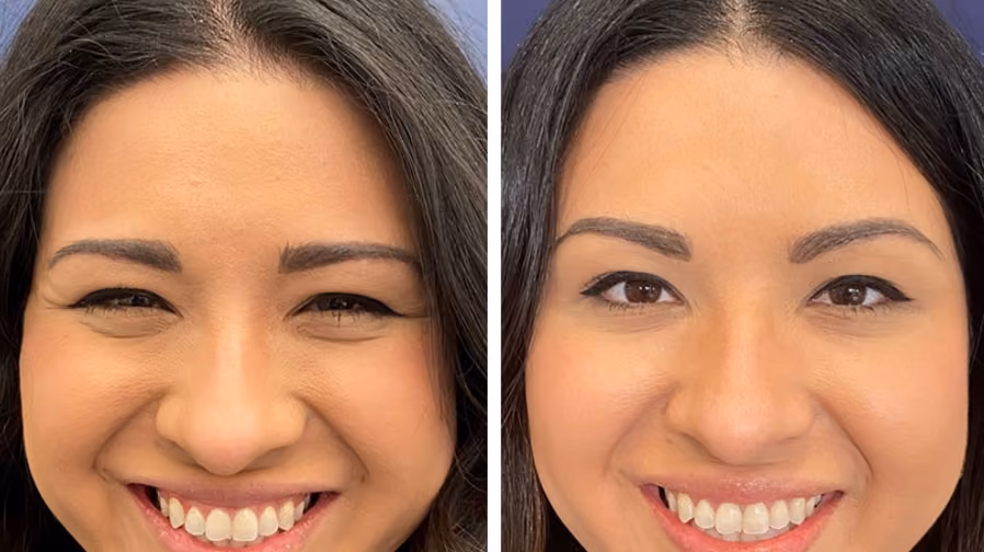 botox crows feet before and after