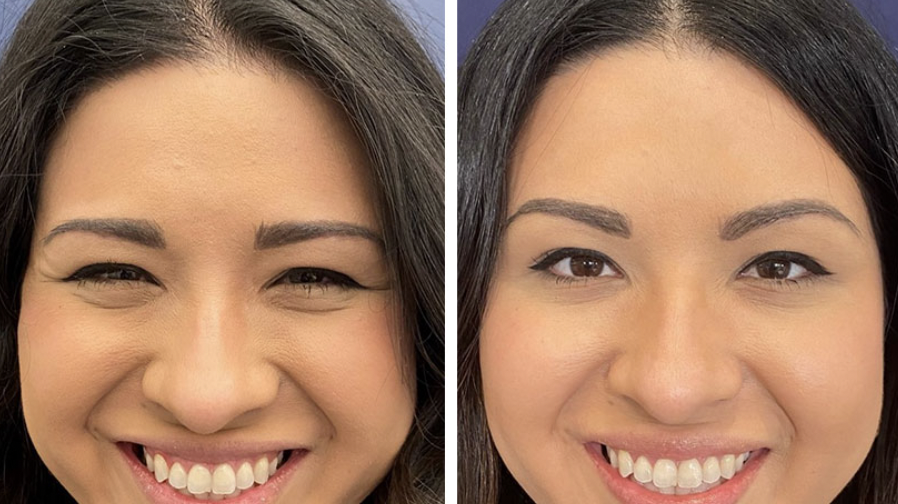 botox crows feet before and after