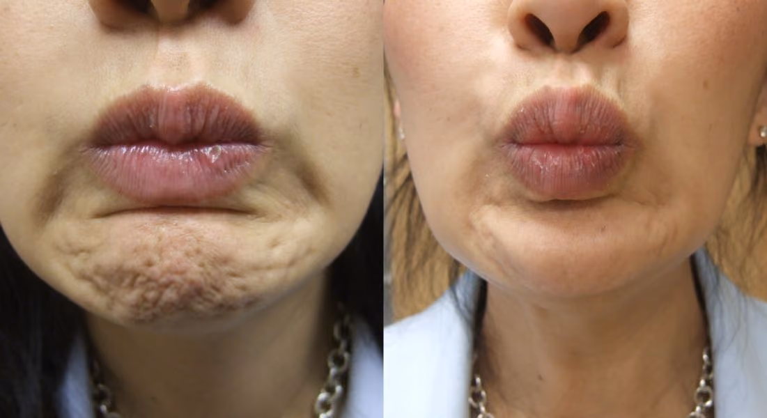 botox lip line before and after