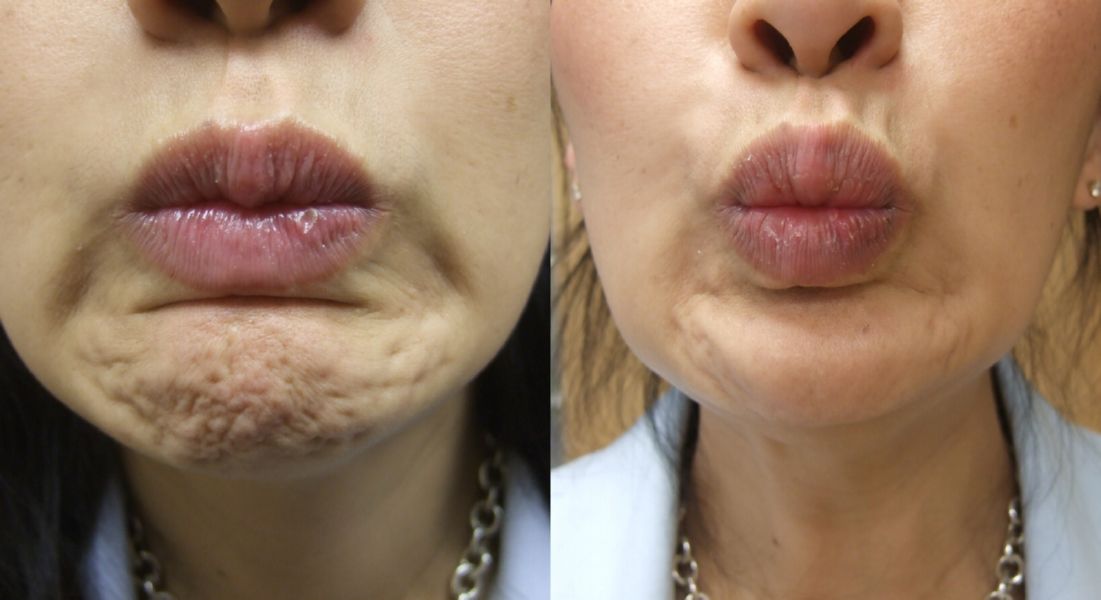 botox lip line before and after